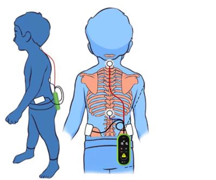 Leading MedTech Company SpineX Releases Groundbreaking Results of New Cerebral Palsy Therapies